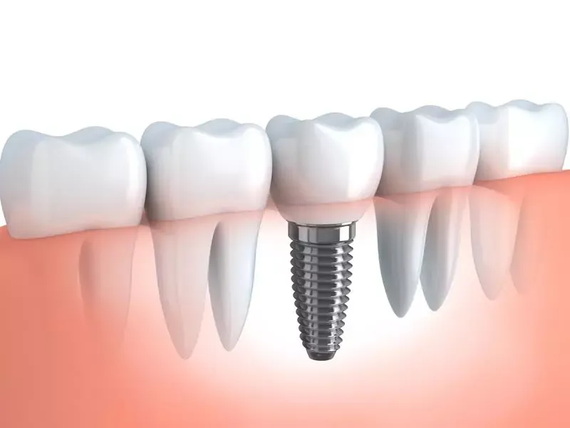 Implant Experience at Scale